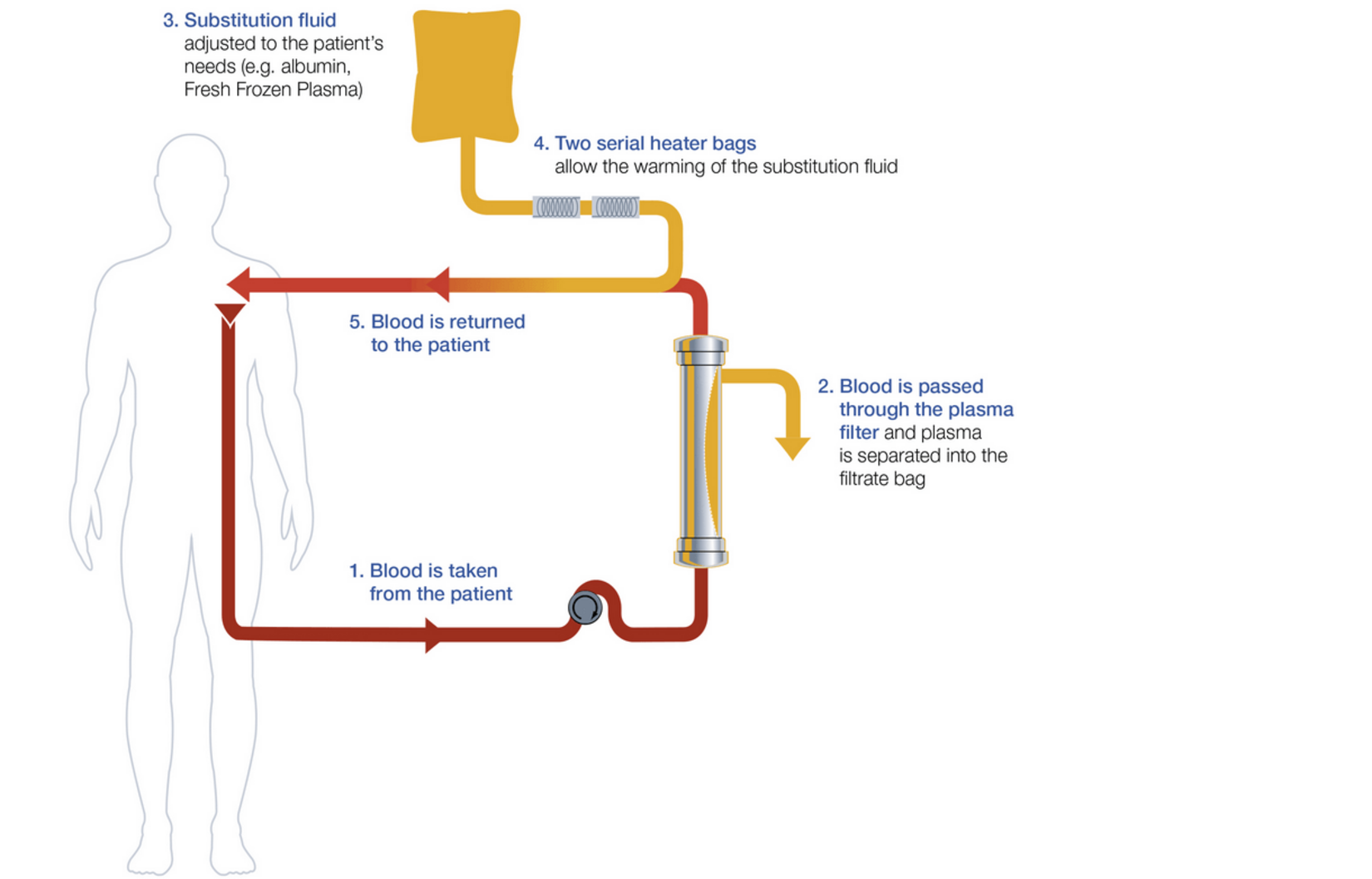 Therapeutic Plasma Exchange (TPE) with multiFiltratePRO