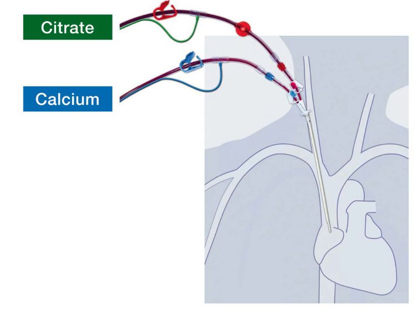 Citrate and calcium infusion for multiFiltrate