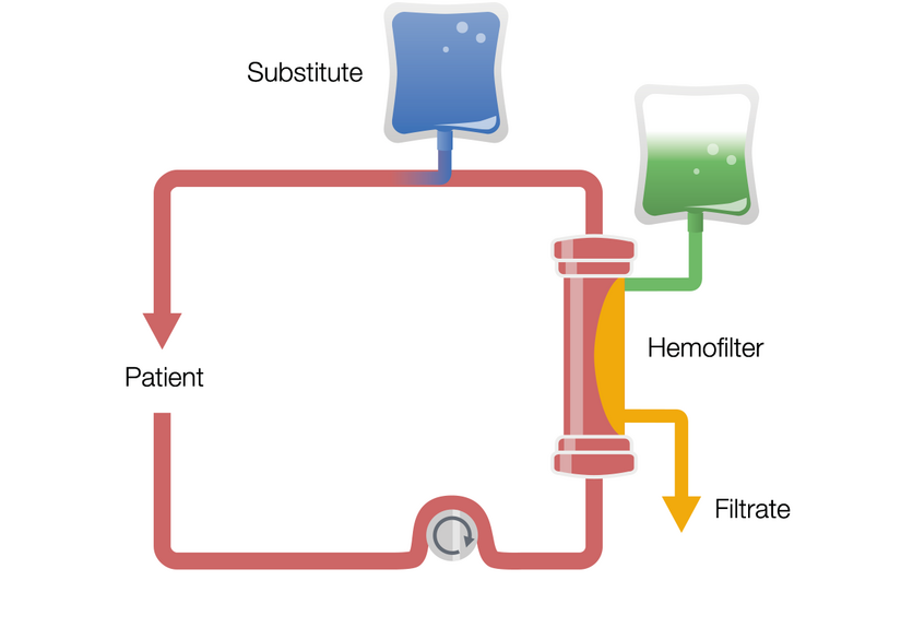 post-dilution CVVHDF