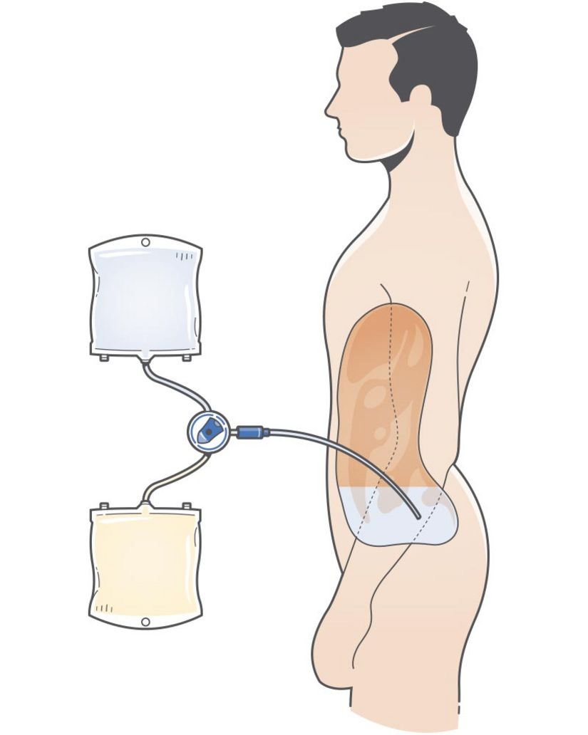 Drawing of Peritoneal Dialysis treatment