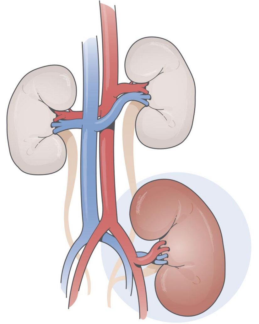 Drawing of a transplanted kidney