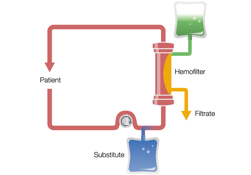 Continuous Veno-Venous Hemodiafiltration in predilution (Pre-CVVHDF)